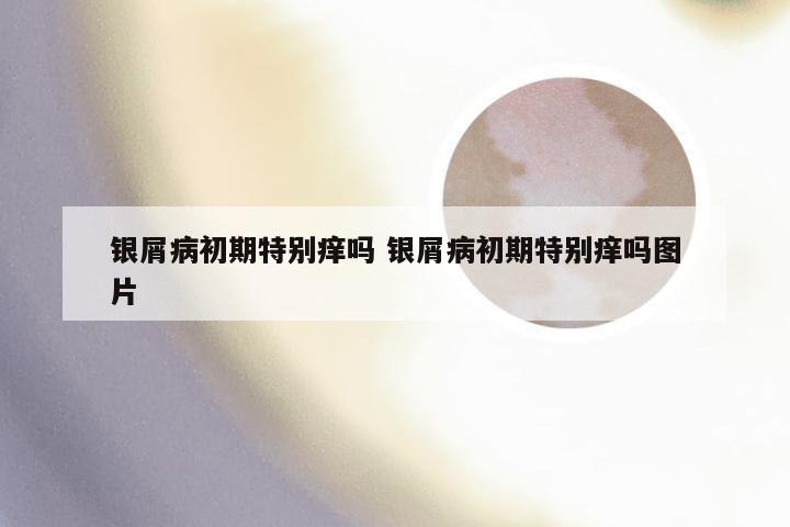 银屑病初期特别痒吗 银屑病初期特别痒吗图片