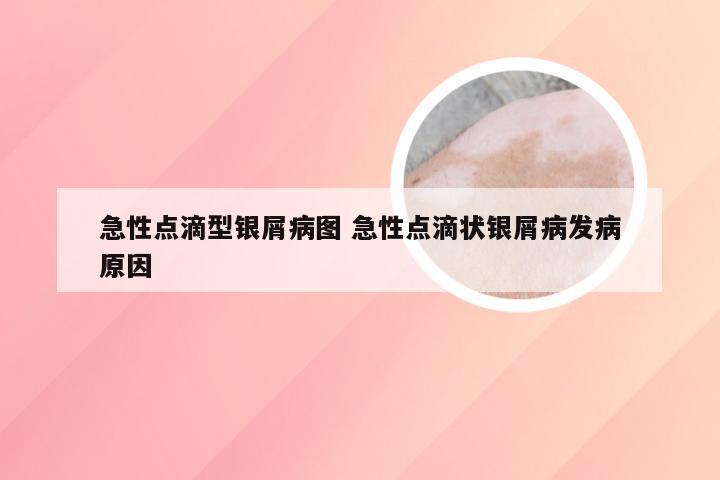 急性点滴型银屑病图 急性点滴状银屑病发病原因