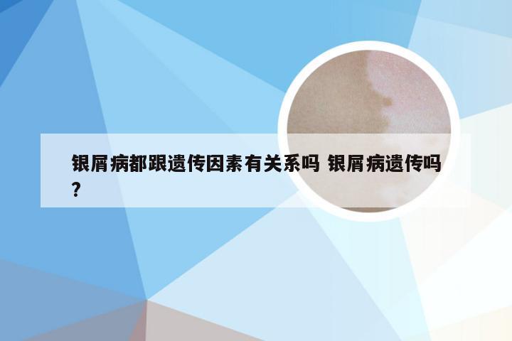 银屑病都跟遗传因素有关系吗 银屑病遗传吗?