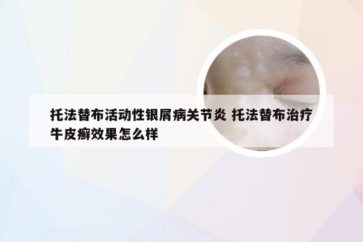 托法替布活动性银屑病关节炎 托法替布治疗牛皮癣效果怎么样