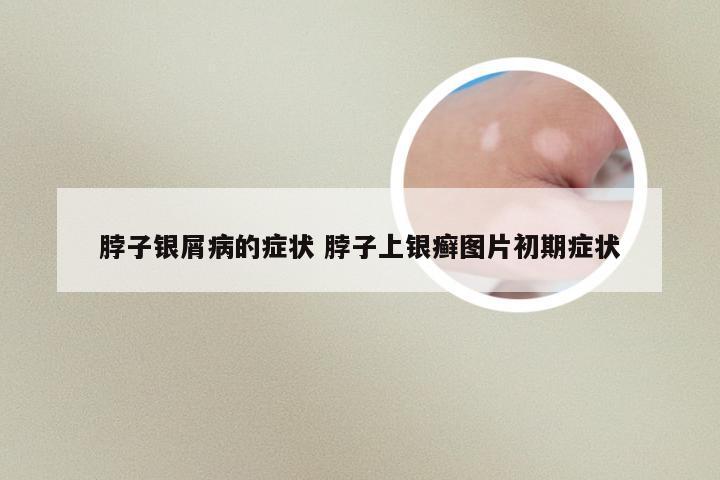 脖子银屑病的症状 脖子上银癣图片初期症状