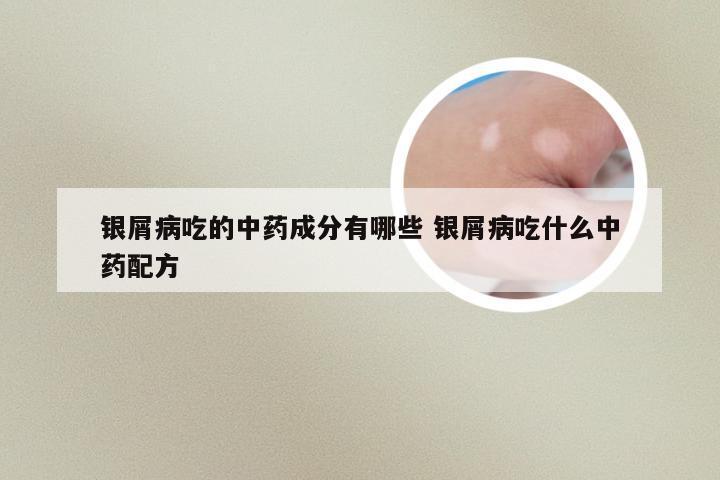 银屑病吃的中药成分有哪些 银屑病吃什么中药配方