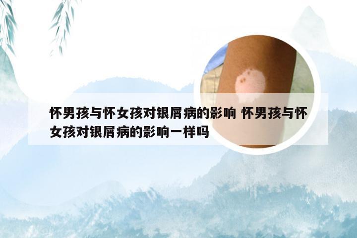 怀男孩与怀女孩对银屑病的影响 怀男孩与怀女孩对银屑病的影响一样吗