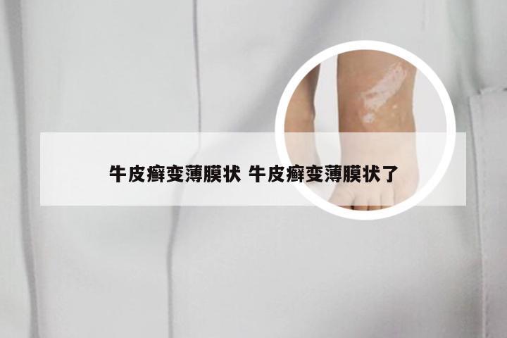 牛皮癣变薄膜状 牛皮癣变薄膜状了