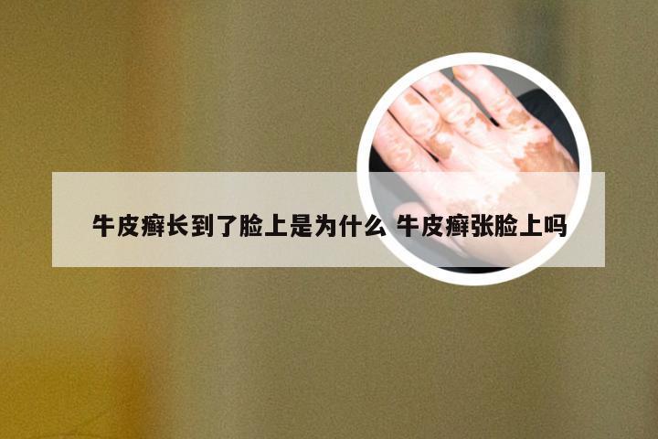 牛皮癣长到了脸上是为什么 牛皮癣张脸上吗