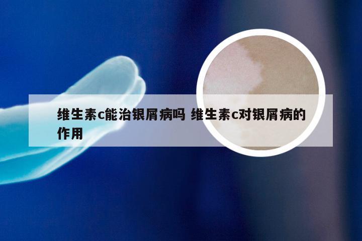 维生素c能治银屑病吗 维生素c对银屑病的作用