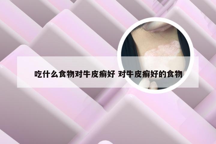 吃什么食物对牛皮癣好 对牛皮癣好的食物