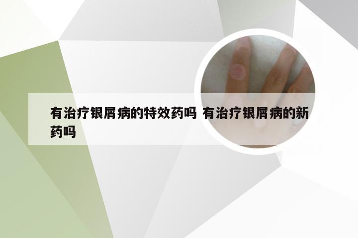 有治疗银屑病的特效药吗 有治疗银屑病的新药吗