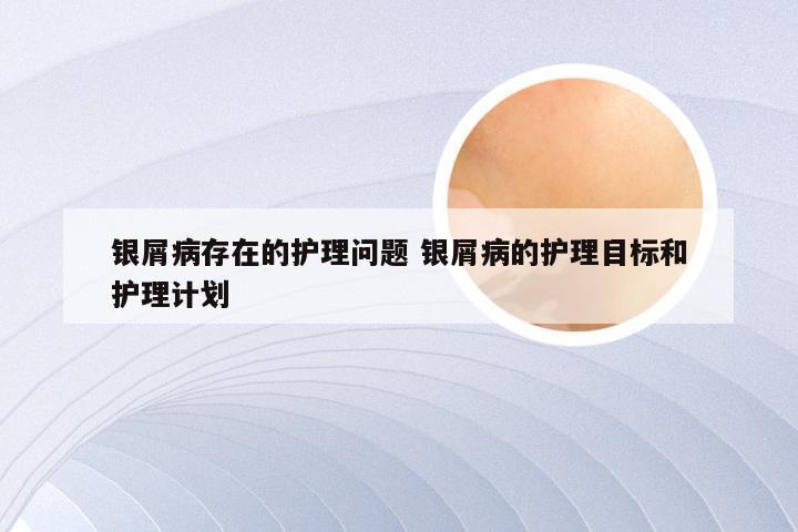 银屑病存在的护理问题 银屑病的护理目标和护理计划