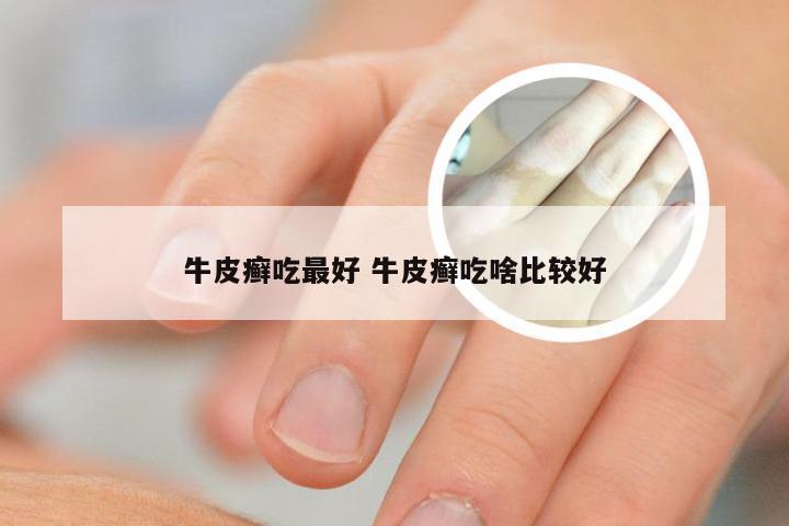 牛皮癣吃最好 牛皮癣吃啥比较好