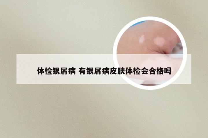 体检银屑病 有银屑病皮肤体检会合格吗