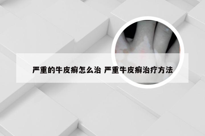 严重的牛皮癣怎么治 严重牛皮癣治疗方法