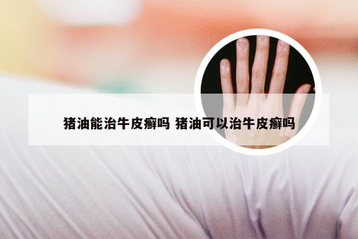 猪油能治牛皮癣吗 猪油可以治牛皮癣吗