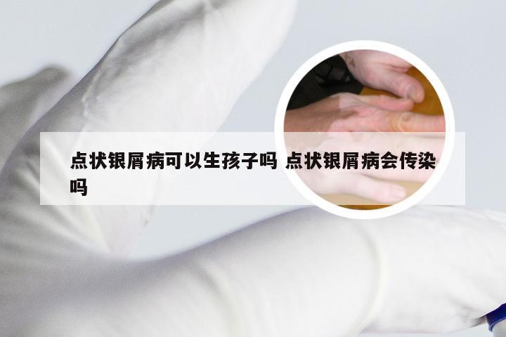 点状银屑病可以生孩子吗 点状银屑病会传染吗