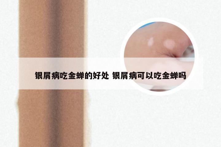 银屑病吃金蝉的好处 银屑病可以吃金蝉吗