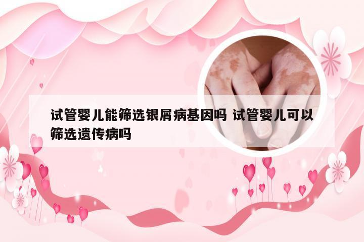 试管婴儿能筛选银屑病基因吗 试管婴儿可以筛选遗传病吗