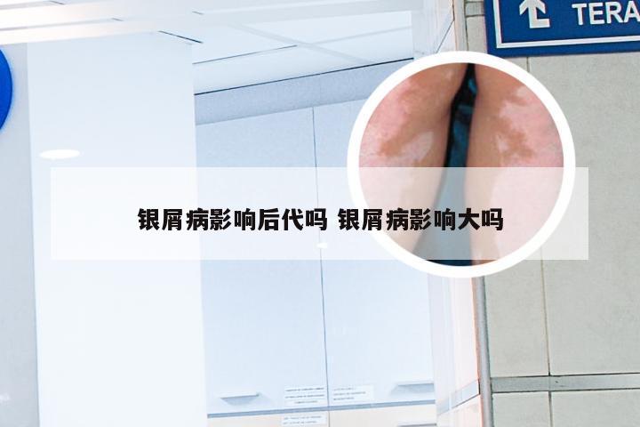 银屑病影响后代吗 银屑病影响大吗