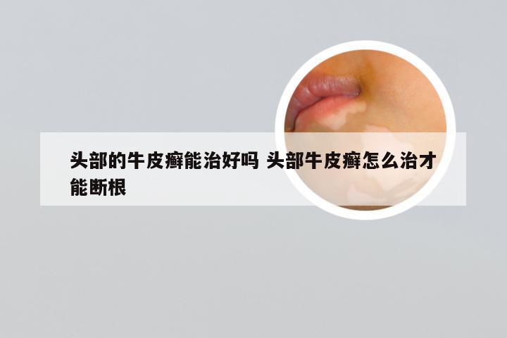 头部的牛皮癣能治好吗 头部牛皮癣怎么治才能断根