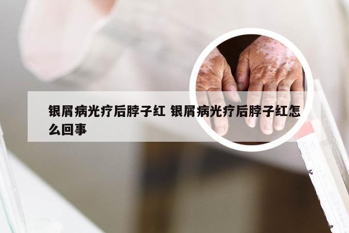 银屑病光疗后脖子红 银屑病光疗后脖子红怎么回事