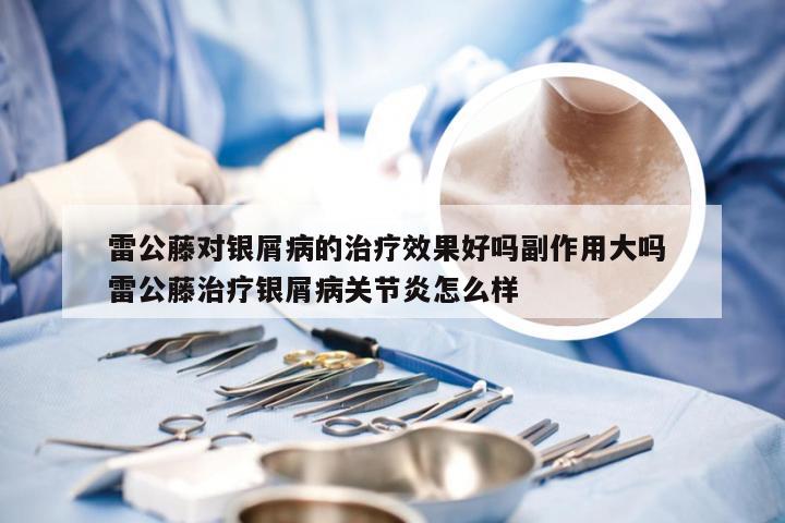 雷公藤对银屑病的治疗效果好吗副作用大吗 雷公藤治疗银屑病关节炎怎么样
