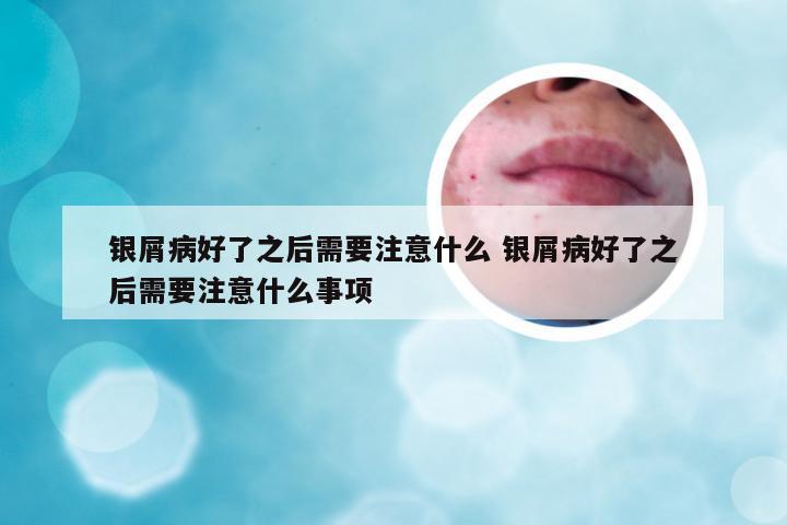 银屑病好了之后需要注意什么 银屑病好了之后需要注意什么事项