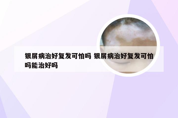 银屑病治好复发可怕吗 银屑病治好复发可怕吗能治好吗