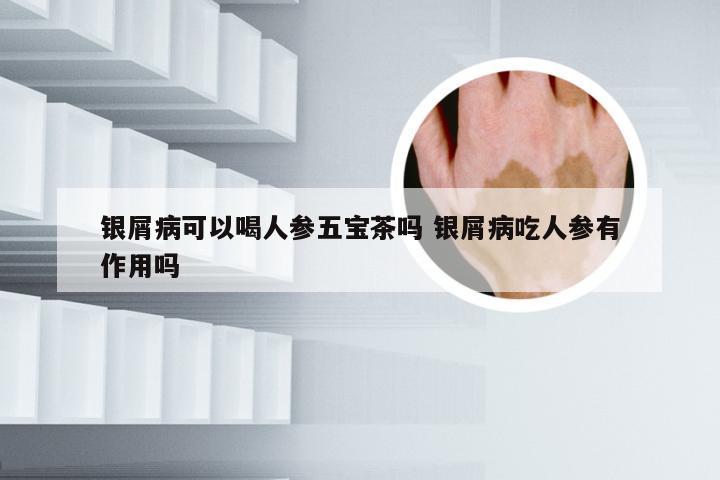 银屑病可以喝人参五宝茶吗 银屑病吃人参有作用吗