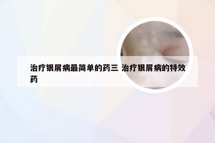 治疗银屑病最简单的药三 治疗银屑病的特效药