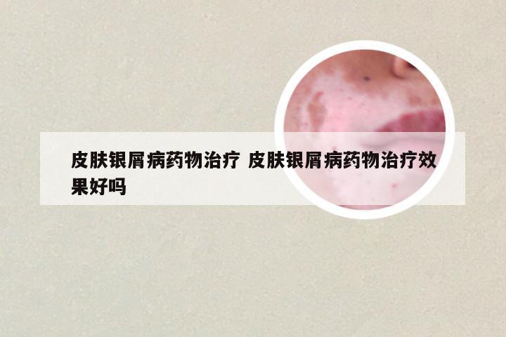 皮肤银屑病药物治疗 皮肤银屑病药物治疗效果好吗