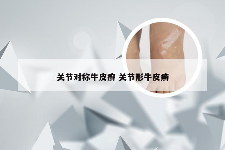 关节对称牛皮癣 关节形牛皮癣