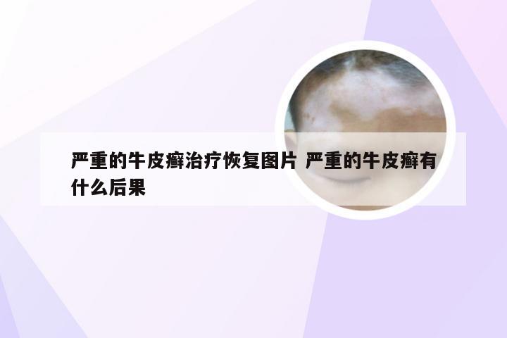 严重的牛皮癣治疗恢复图片 严重的牛皮癣有什么后果