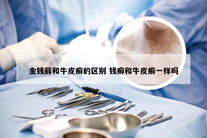 金钱藓和牛皮癣的区别 钱癣和牛皮癣一样吗