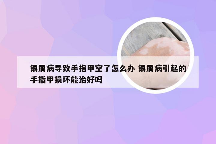 银屑病导致手指甲空了怎么办 银屑病引起的手指甲损坏能治好吗