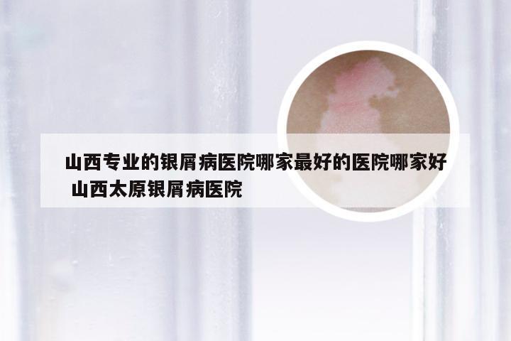 山西专业的银屑病医院哪家最好的医院哪家好 山西太原银屑病医院