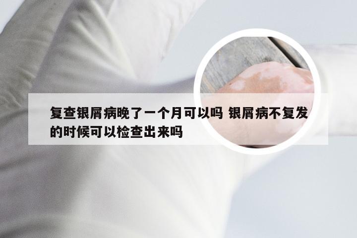 复查银屑病晚了一个月可以吗 银屑病不复发的时候可以检查出来吗