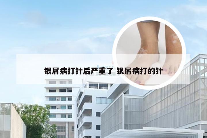银屑病打针后严重了 银屑病打的针