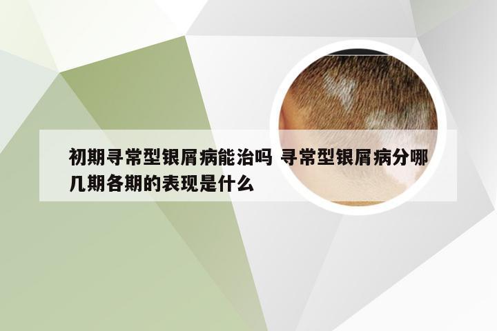 初期寻常型银屑病能治吗 寻常型银屑病分哪几期各期的表现是什么