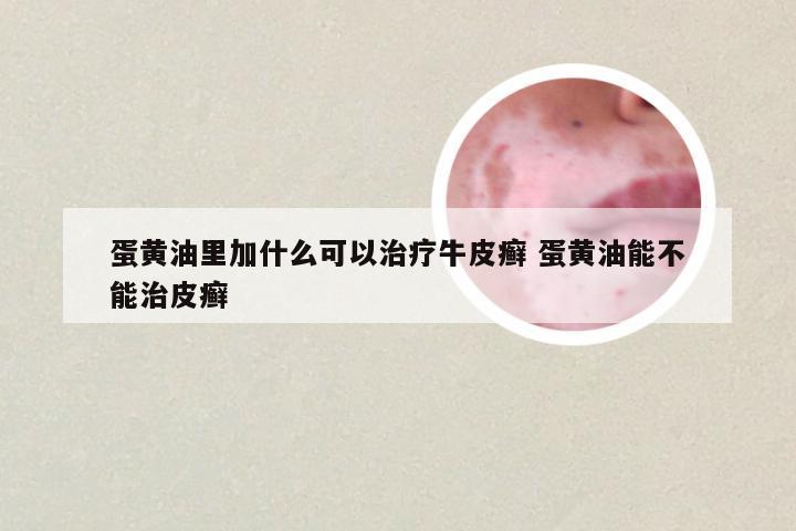 蛋黄油里加什么可以治疗牛皮癣 蛋黄油能不能治皮癣