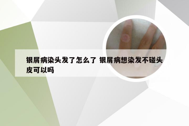银屑病染头发了怎么了 银屑病想染发不碰头皮可以吗