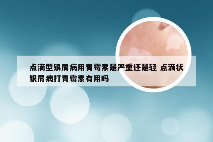 点滴型银屑病用青霉素是严重还是轻 点滴状银屑病打青霉素有用吗