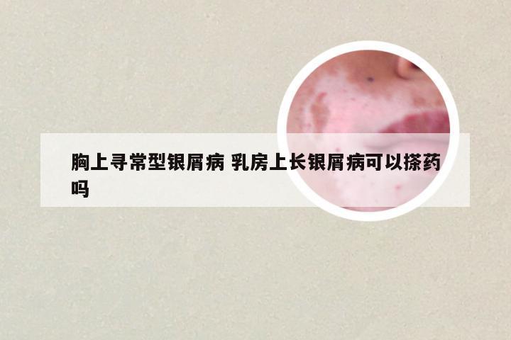 胸上寻常型银屑病 乳房上长银屑病可以搽药吗