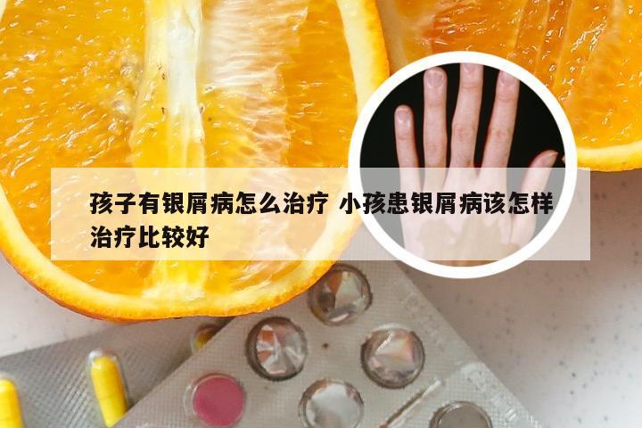 孩子有银屑病怎么治疗 小孩患银屑病该怎样治疗比较好