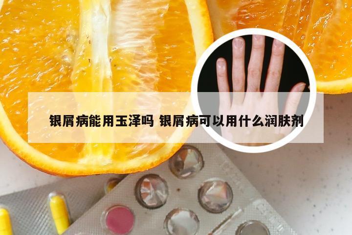 银屑病能用玉泽吗 银屑病可以用什么润肤剂
