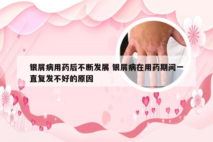 银屑病用药后不断发展 银屑病在用药期间一直复发不好的原因