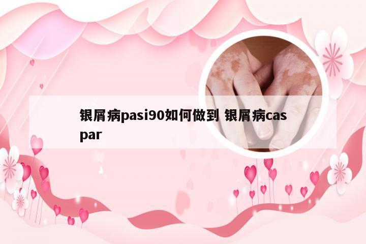 银屑病pasi90如何做到 银屑病caspar