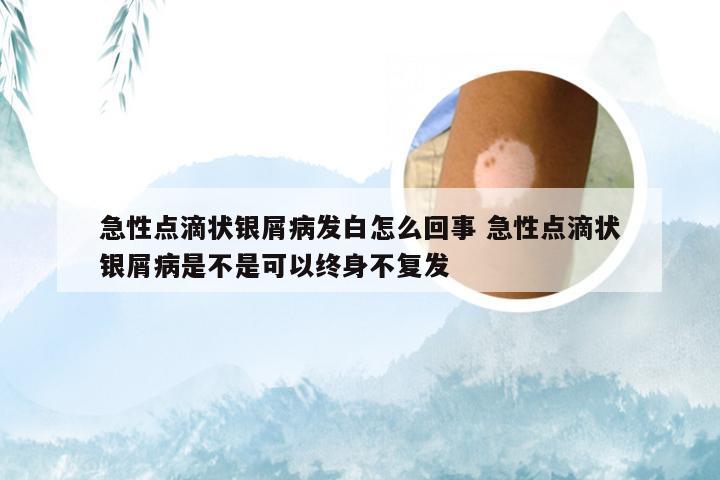 急性点滴状银屑病发白怎么回事 急性点滴状银屑病是不是可以终身不复发