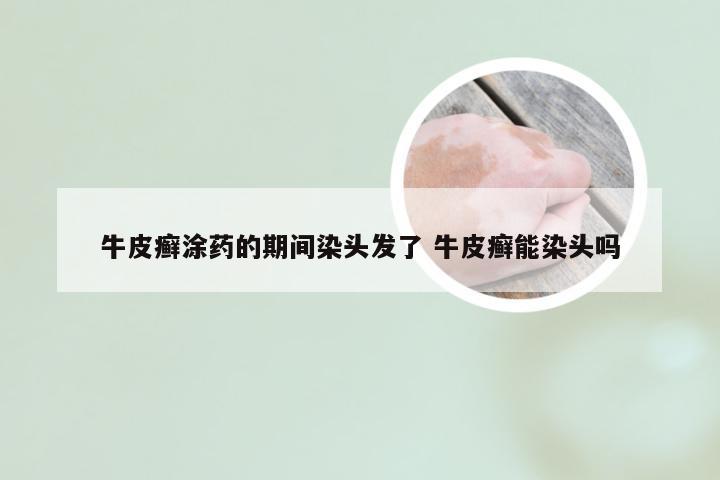 牛皮癣涂药的期间染头发了 牛皮癣能染头吗