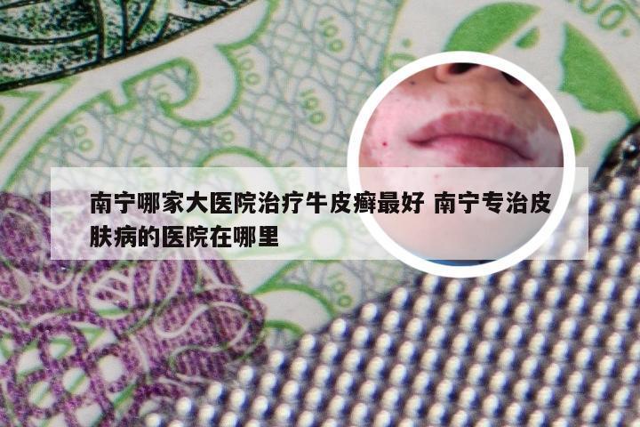 南宁哪家大医院治疗牛皮癣最好 南宁专治皮肤病的医院在哪里