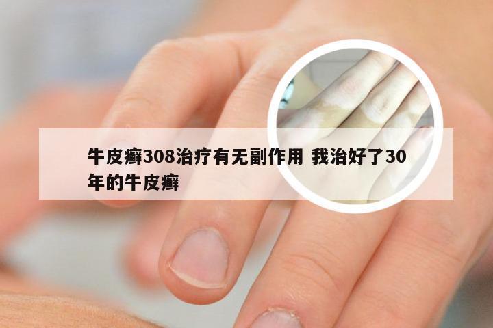 牛皮癣308治疗有无副作用 我治好了30年的牛皮癣