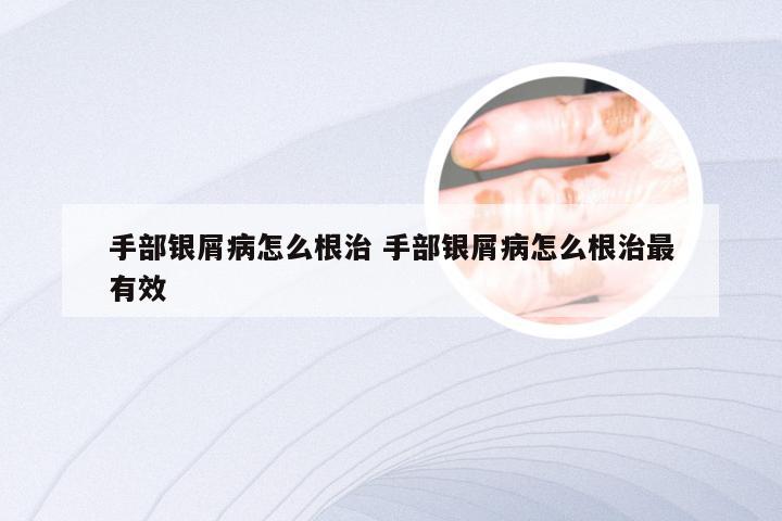 手部银屑病怎么根治 手部银屑病怎么根治最有效